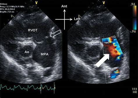 Abnormalities Of Right Ventricular Outflow Echocardiography In