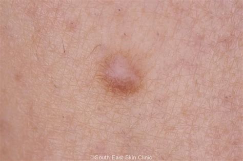 Dermatofibroma South East Skin Clinic Blog
