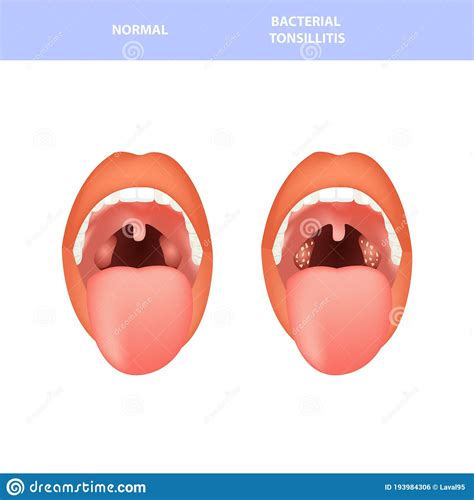 Tonsils Vector Illustration Tonsillitis Labeled Structure Diagram