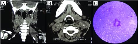 Aandb Ct Scan Of The Cervical Region Revealed Multiple Lymph Node