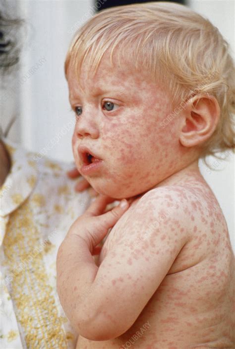 Baby Boy With Measles Rash Stock Image M2100003 Science Photo