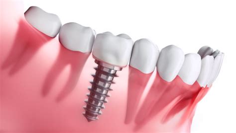 A Step By Step Guide To Dental Implants
