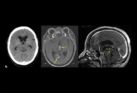 Brain Lesions Summaries Of 10 Cases