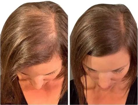 Hair Sprays To Cover Bald Spots 2022 Top 6 Picks Stages Of Balding