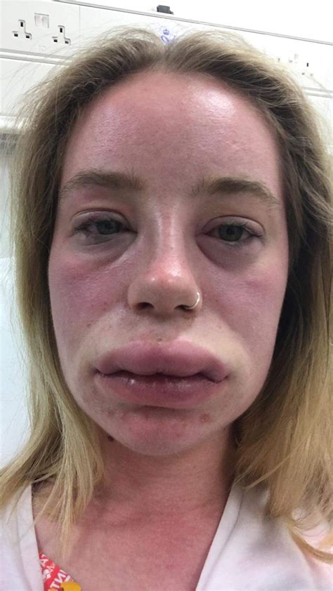 is swollen lips an allergic reaction