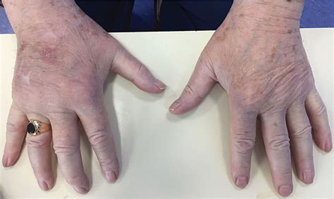 Image Of The Month Remitting Seronegative Symmetrical Synovitis With