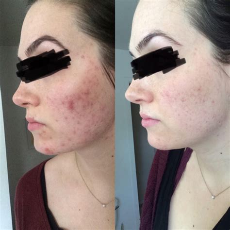 8 Different Types Of Laser Treatments For Acne Scars Singapore Beauty