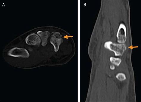 Nonoperative Comminuted Hamate Fracture Journal Of Orthopaedic