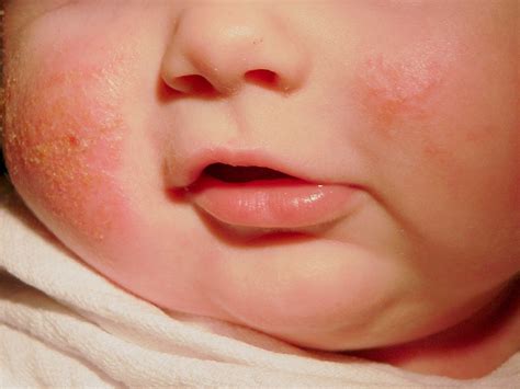 Pediatric Atopic Dermatitis Skin Directed Approach Key