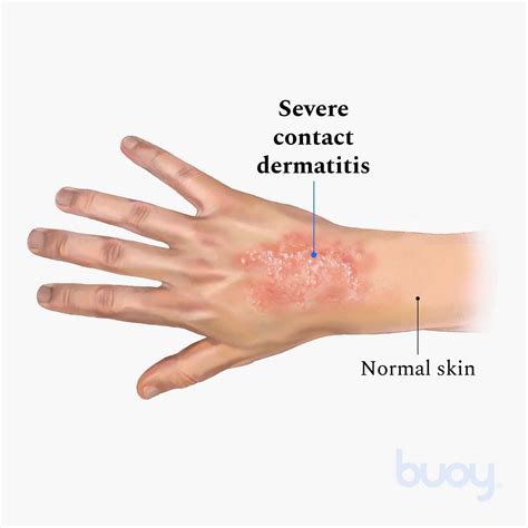 Understanding Nickel Allergic Contact Dermatitis And Its Causes