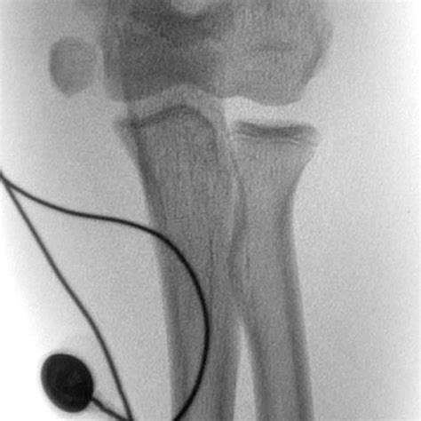 Pdf Extraction Of Incarcerated Medial Epicondyle From The Elbow Joint