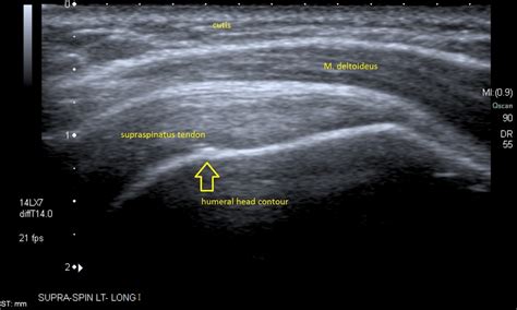 Shoulder Muscle Anatomy Deltoid