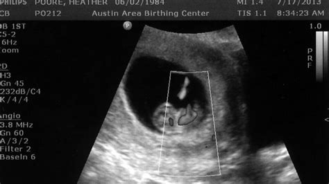 The Dating Ultrasound At 9 Weeks To Determine The Due Date Of The Baby