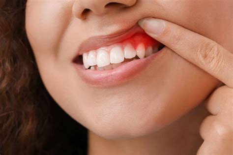 Gum Health Healthy Gums Gum Care Tips