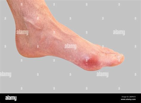 Foot Disease Rheumatism And Gout Red Leg Swelling Pain In The Foot