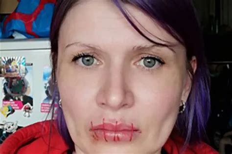 Russian Woman Sews Her Own Mouth Shut In Anti War Protest Daily Star