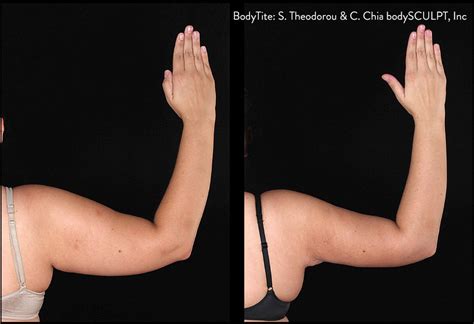 Bodytite By Inmode — Minimally Invasive Body Contouring In Just One
