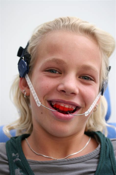 Orthodontiepraktijk Leeuwarden Van Beek Activator Orthodontiepraktijk Leeuwarden