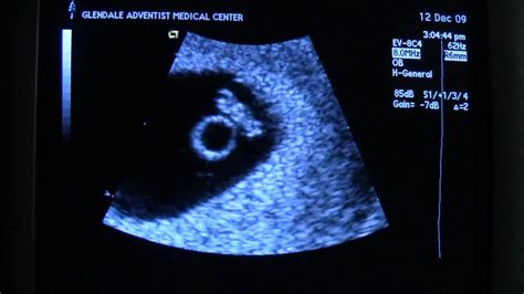 Ultrasound 6 Weeks 6 Days Heartbeat Youtube