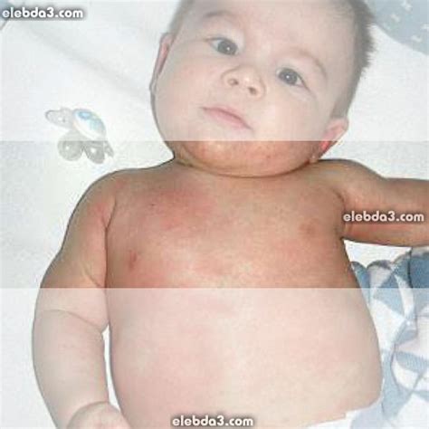 حساسية الجلد عند الاطفال بالصور