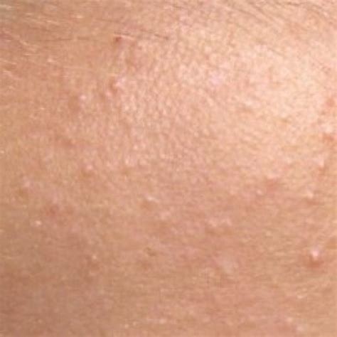 Sebaceous 1024x1024 Valley Medical Aesthetics