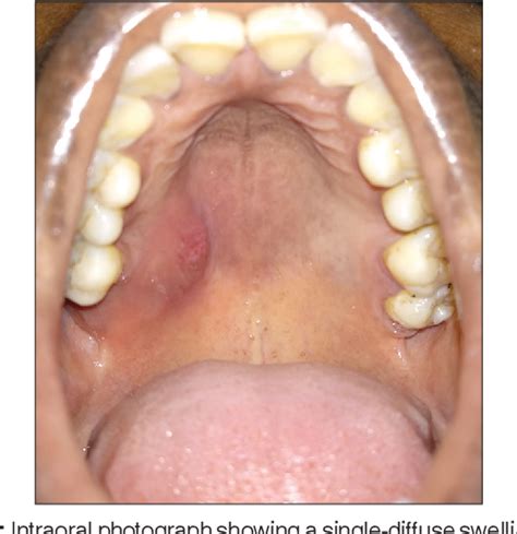 Figure 1 From Benign Lymphoepithelial Lesion Of The Minor Salivary