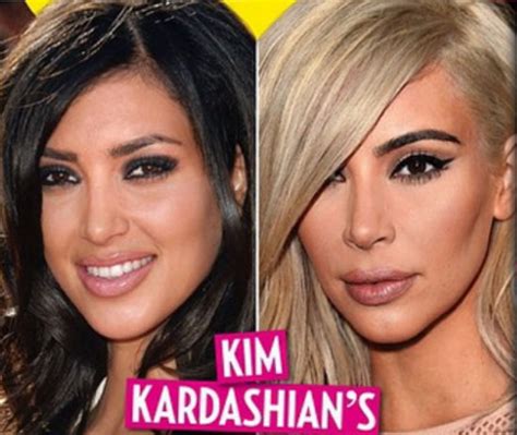 Kim Kardashian Plastic Surgery Procedures And Proof Plastic Surgery