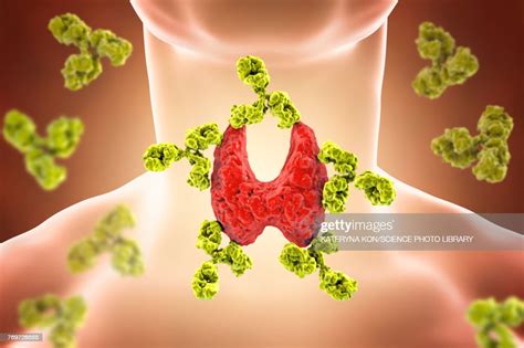 Autoimmune Thyroiditis Conceptual Illustration High Res Vector Graphic