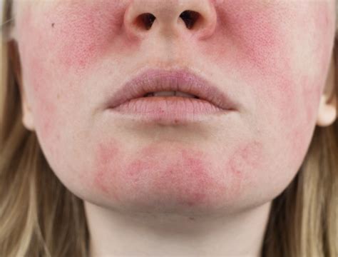 Difference Between A Lupus Rash And Rosacea Difference Between