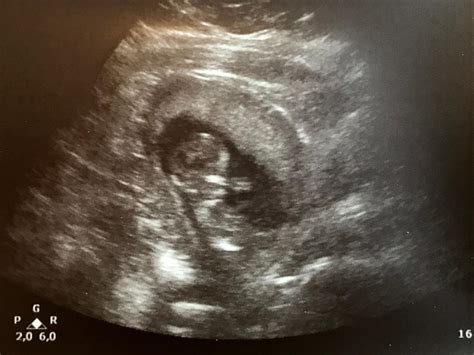Ssw) und hast die kritische phase und damit bereits das erste trimenon überstanden. 13.ssw Embryo zu klein? | Forum Schwangerschaft - urbia.de