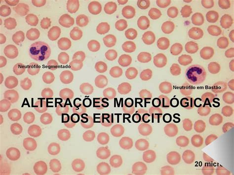 Aula Alteracoes Morfologicas Dos Eritrocitos