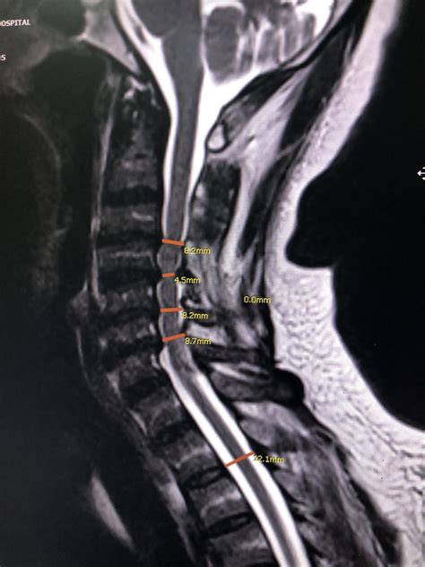 Tandem Stenosis Compression At Cervical And Lumbar Spine Spineadvise