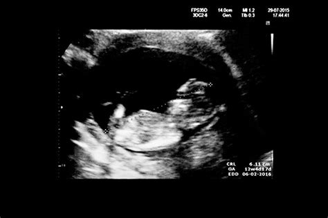 12 Week Ultrasound Baby Scan What Will It Tell Me Madeformums