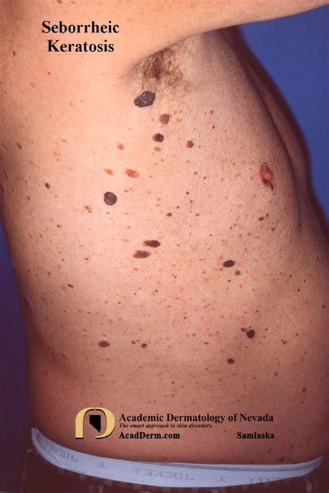 Brown Spots Seborrheic Keratosis Phillips Aesthetic Dermatology My