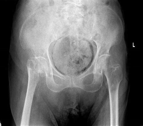 an unusual pelvis radiograph the bmj