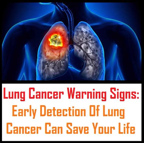 Lung Cancer Warning Signs Early Detection Of Lung Cancer Can Save Your