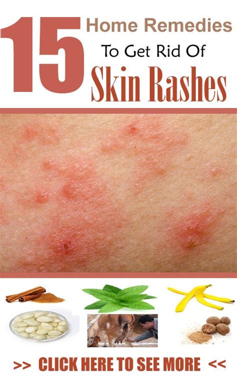 17 Best Images About Remedies On Pinterest Health Spots On Skin And