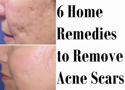 6 Home Remedies To Remove Acne Scars Skinnyzine