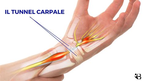 Sindrome Del Tunnel Carpale Sintomi Rimedi E Come Riconoscerla Greenme