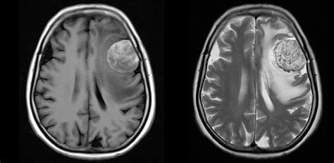 Ultimate Radiology Hemorrhagic Dural And Parenchymal Metastases Brain