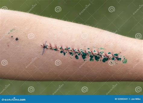 Wound With Stitches After Surgery Operation Royalty Free Stock