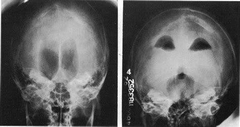 Symptomatic Occult Hydrocephalus With Normal Cerebrospinal Fluid