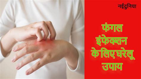 Home Remedies For Fungal Infection क्या आप हैं फंगल इंफेक्शन से परेशान