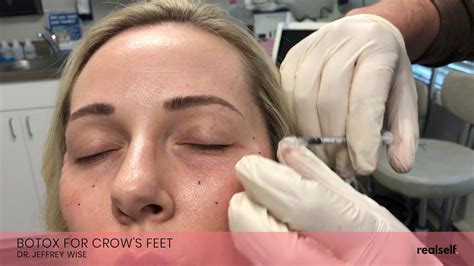 Botox Injections To Get Rid Of Crow S Feet Youtube
