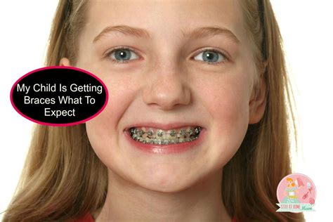How much it cost to get braces ? What To Expect When Your Child Gets Braces | Stay at Home Mum