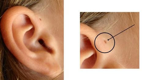 Preauricular Sinus Surgery Cost Save 10 Surgical Cost