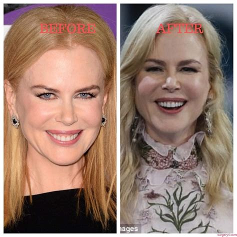 Nicole Kidman Plastic Surgery Photos [Before & After] ⋆ Surgery4