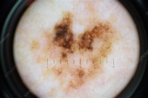 Mole On The Skin Dermoscopy Image Stock Image C0564432 Science