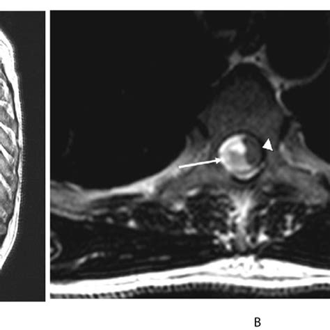 Sagittal A And Axial B T2wi Show An Intradural Mass At The Level
