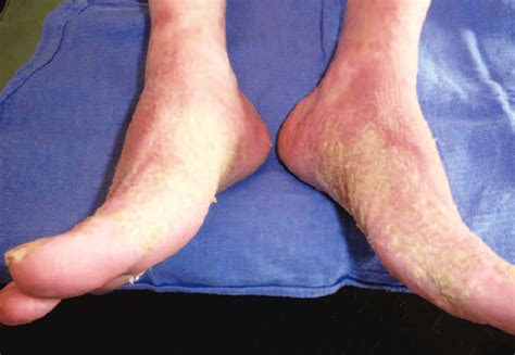 Case Report No 3 Hyperkeratosis Of The Inner Part Of The Feet